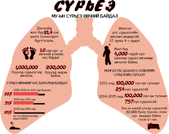 2024 онд сүрьеэ өвчнөөр 415 хүн нас барсан байна