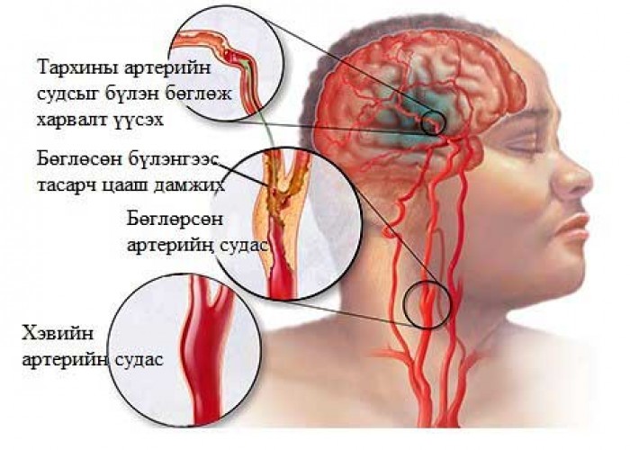 Тархины цус харвалтын тусламж, үйлчилгээг ЭМД-аас бүрэн хариуцна