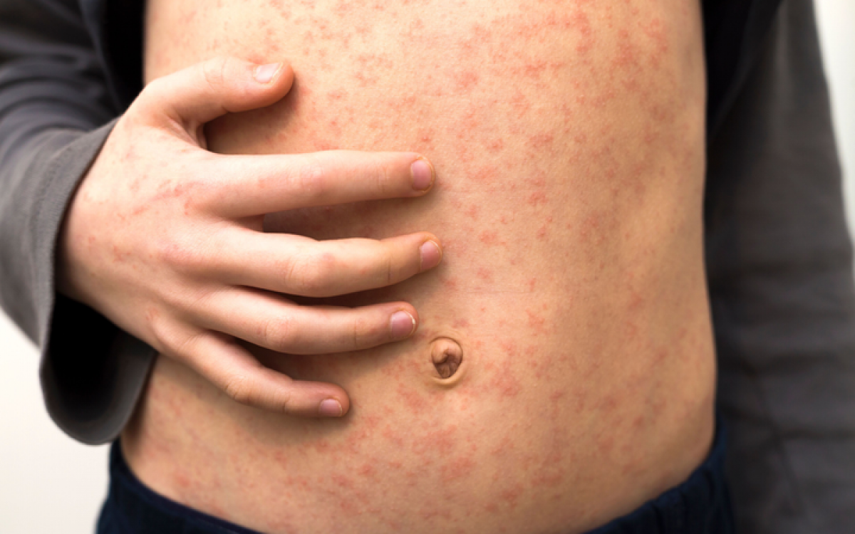 Улаанбурхан өвчний нийт батлагдсан тохиолдол 13.541 хүрлээ