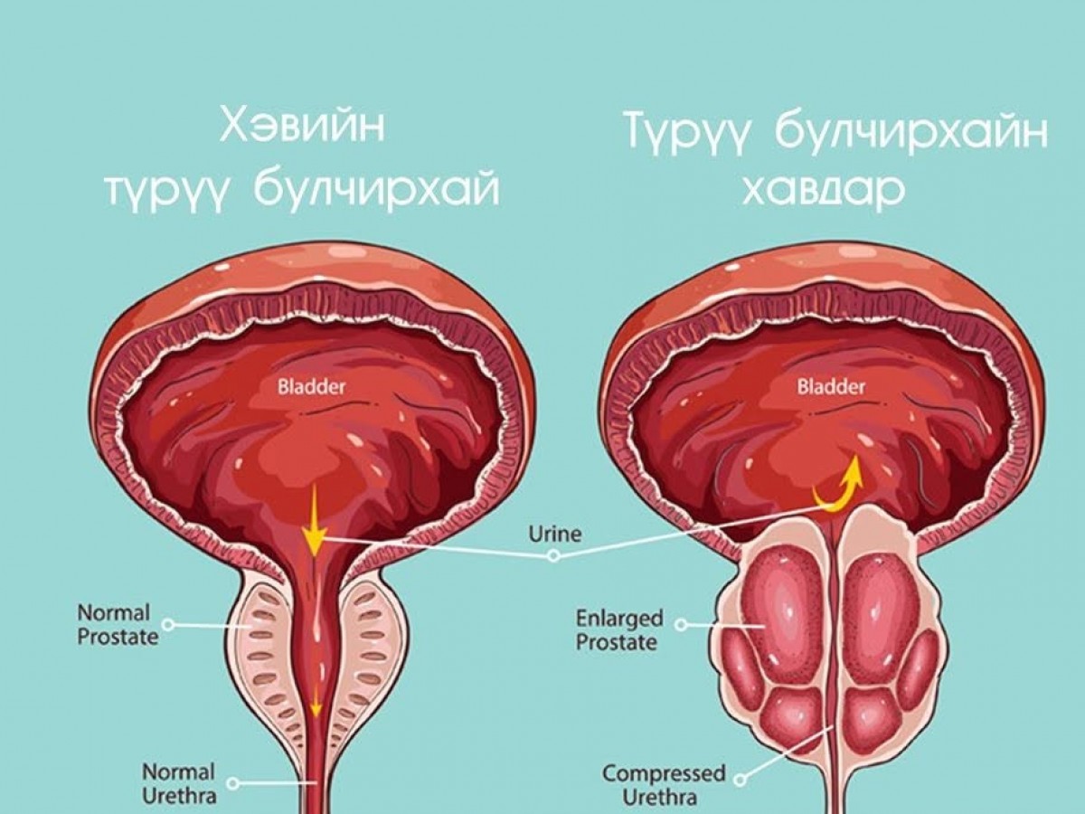 Англи Улсад түрүү булчирхайн хорт хавдрын шинэ эмчилгээ хийж эхэлжээ
